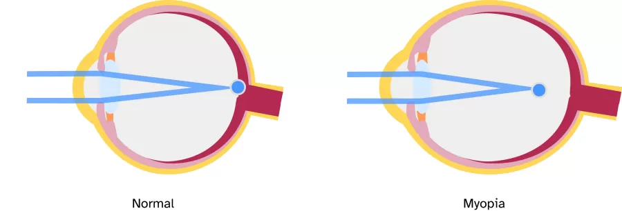 an image of a normal and a myopic eye