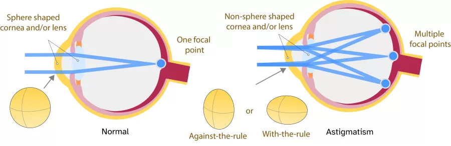 an illustration of astigmatism
