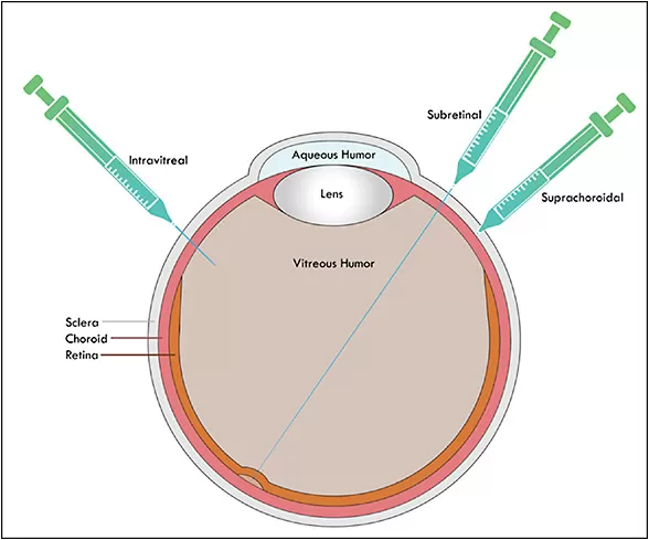 an illustration of different injection sites