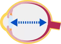 an illustration of eye elongation